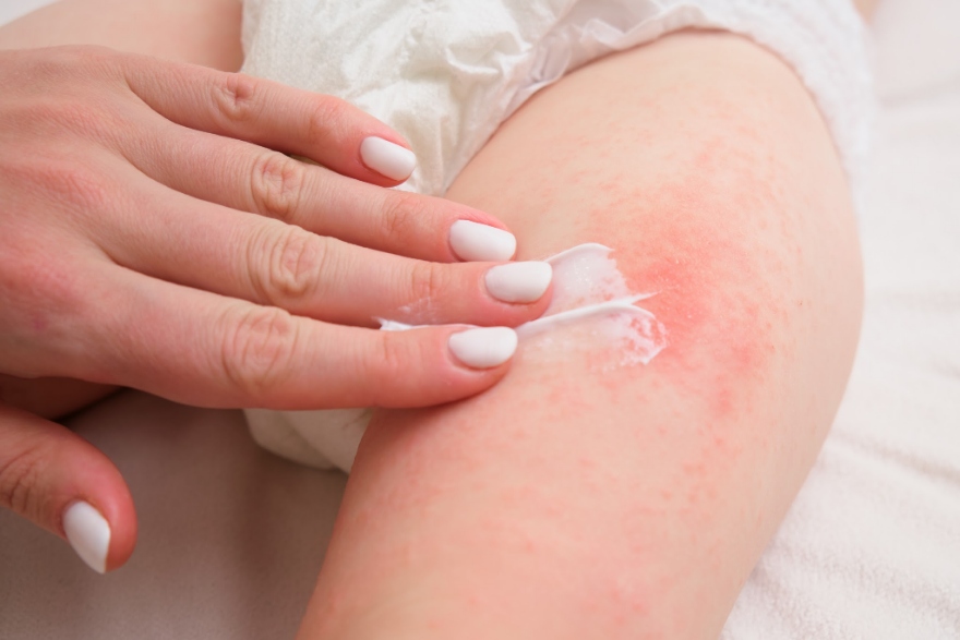 Chăm sóc trẻ sơ sinh bị rôm sảy bằng cách giữ da sạch, khô thoáng.