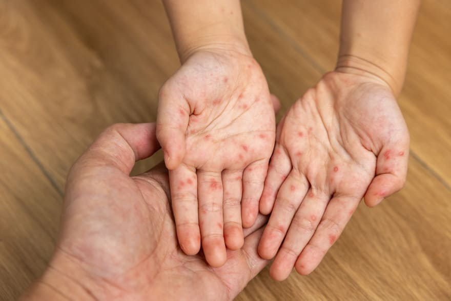 Mụn nước nổi ở lòng bàn tay là dấu hiệu bệnh tay chân miệng