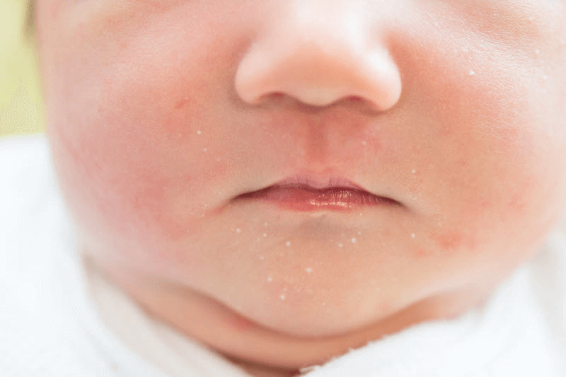 Trẻ sơ sinh bị mụn sữa