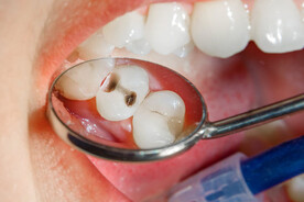 cách trị sâu răng cho bé