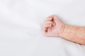 trẻ sơ sinh bị nổi mẩn đỏ