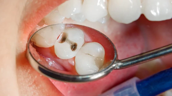 cách trị sâu răng cho bé